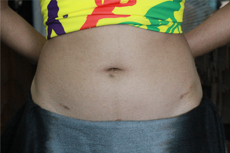 Stomach Pictures After Myomectomy Surgery